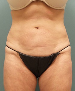 Tummy Tuck Before & After Photo