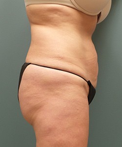 Tummy Tuck Before & After Photo