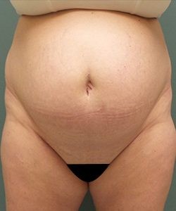 Tummy Tuck Before & After Photo