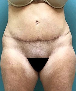 Tummy Tuck Before & After Photo