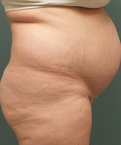 Tummy Tuck Before & After Photo