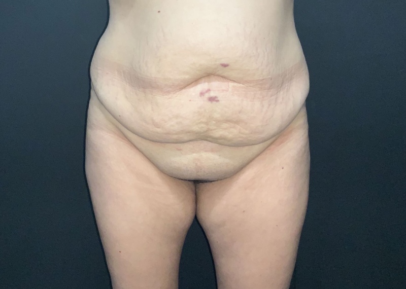 Tummy Tuck Before & After Photo