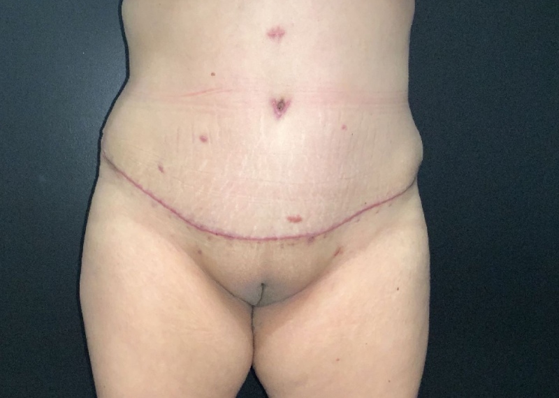 Tummy Tuck Before & After Photo