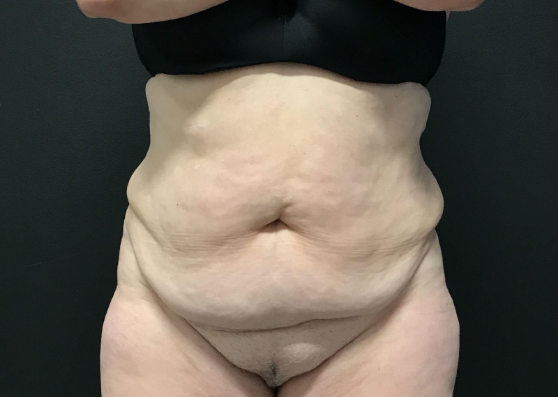 Tummy Tuck Before & After Photo