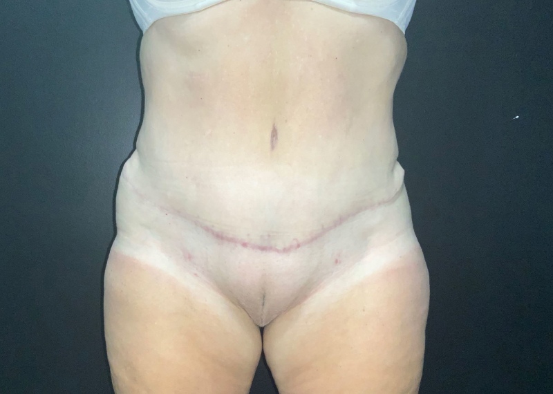 Tummy Tuck Before & After Photo