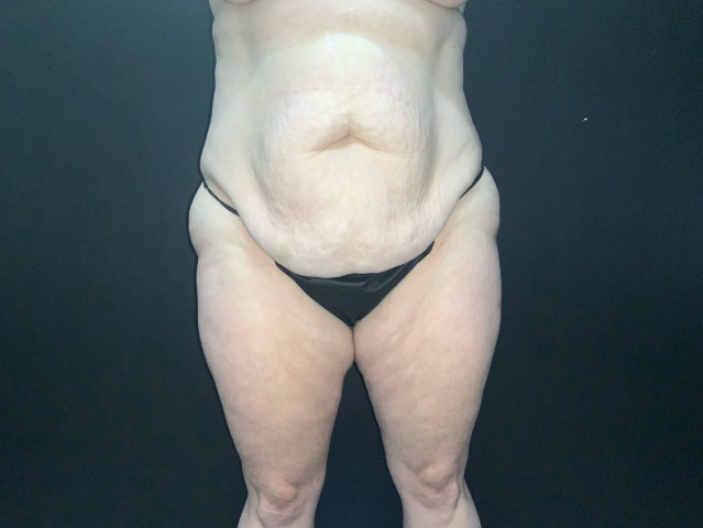 Tummy Tuck Before & After Photo