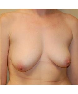 Breast Asymmetry Correction Before & After Photo