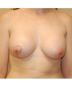 Breast Asymmetry Correction Before & After Photo