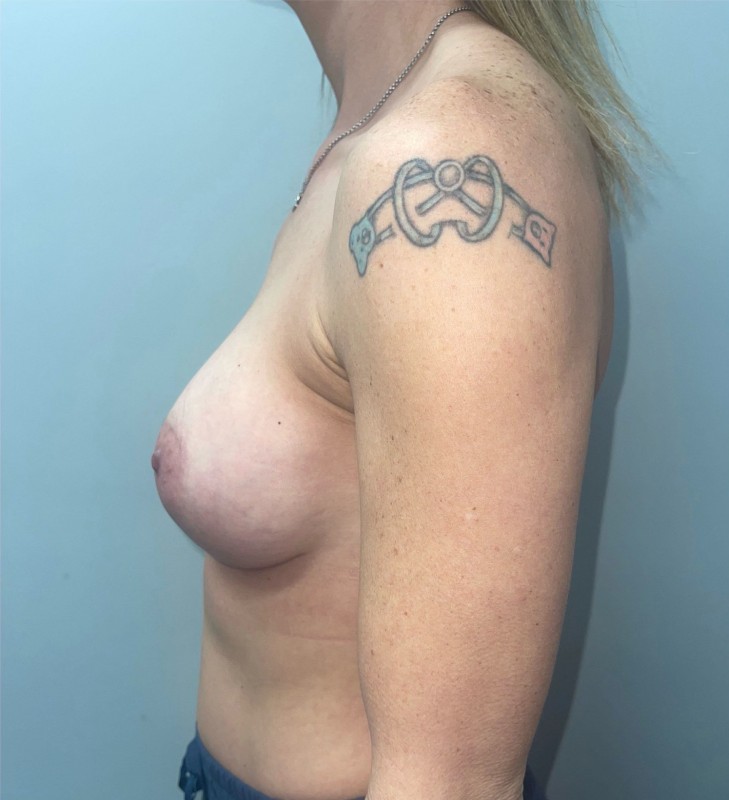 Breast Augmentation Before & After Photo