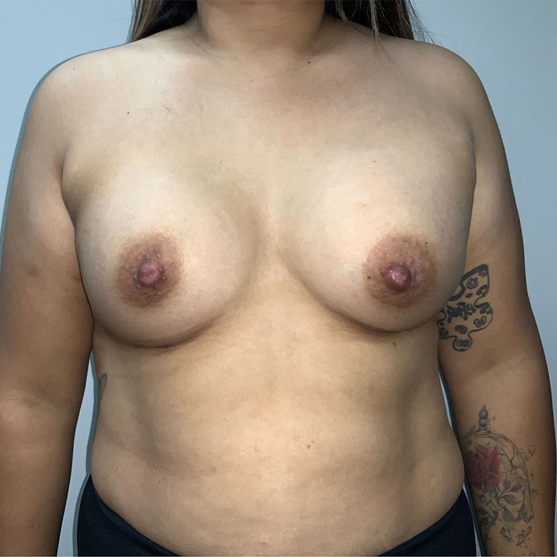 Breast Augmentation Before & After Photo