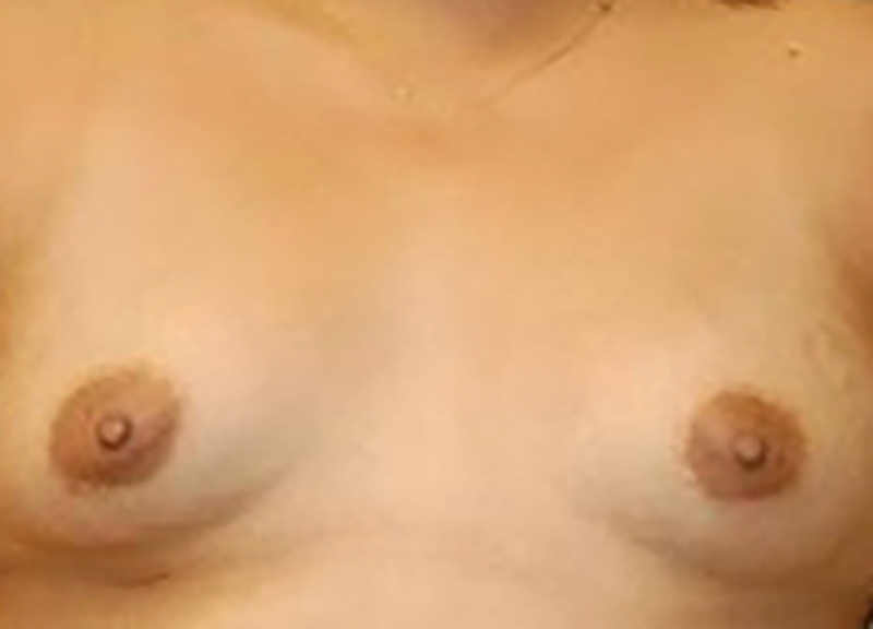 Breast Augmentation Before & After Photo