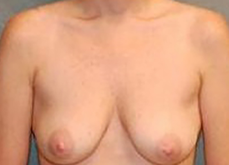 Breast Augmentation Before & After Photo