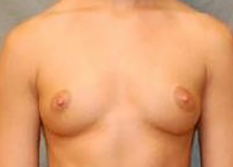 Breast Augmentation Before & After Photo