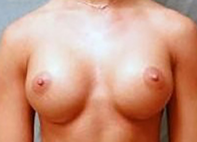 Breast Augmentation Before & After Photo