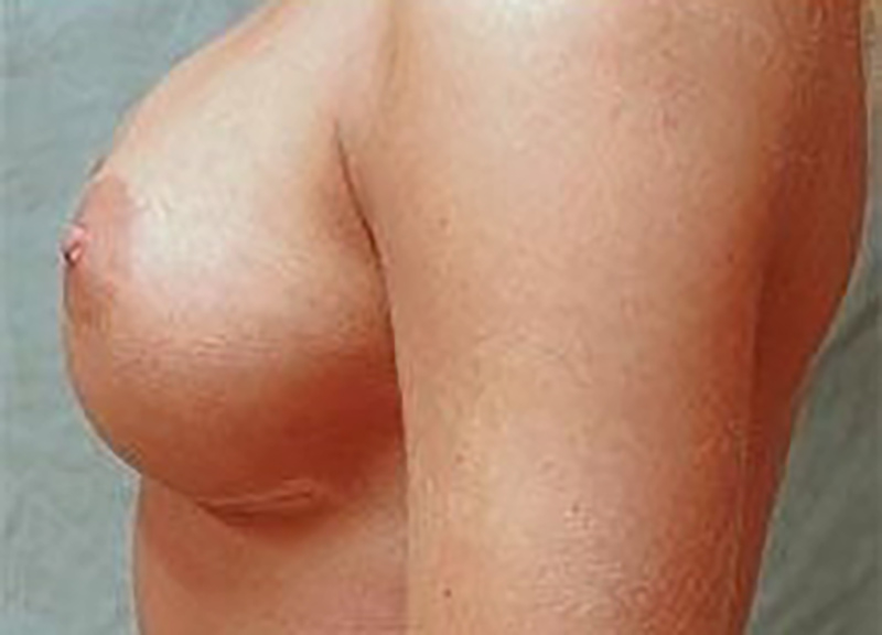 Breast Augmentation Before & After Photo