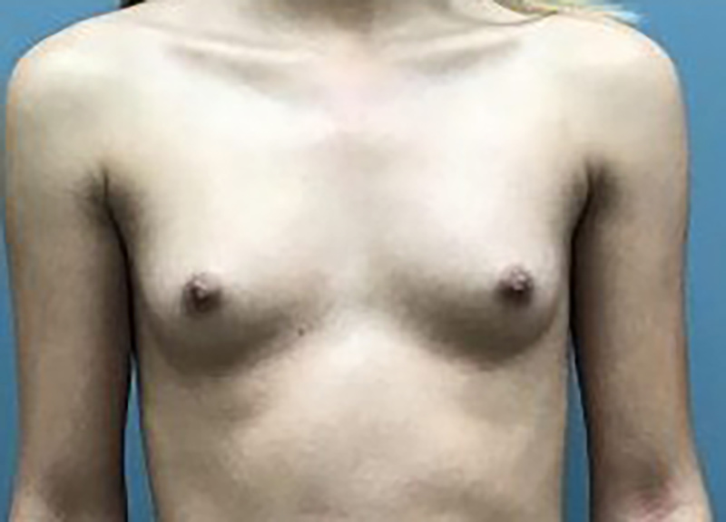 Breast Augmentation Before & After Photo