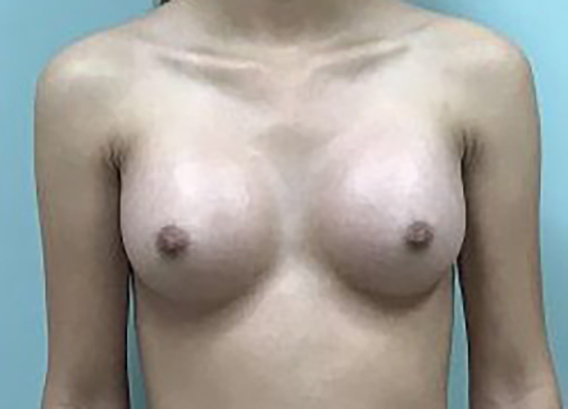 Breast Augmentation Before & After Photo