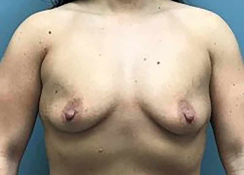 Breast Augmentation Before & After Photo