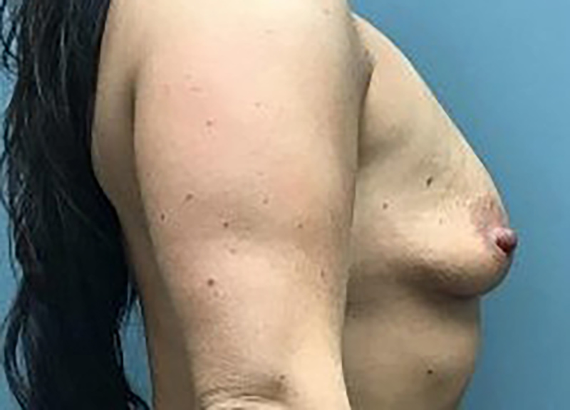 Breast Augmentation Before & After