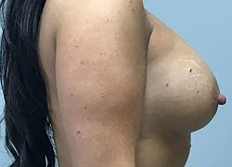 Breast Augmentation Before & After