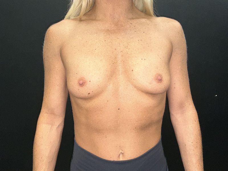 Breast Augmentation Before & After