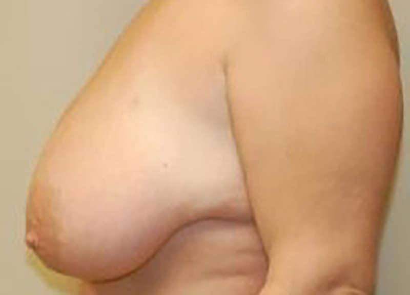 Breast Lift Before & After Photo