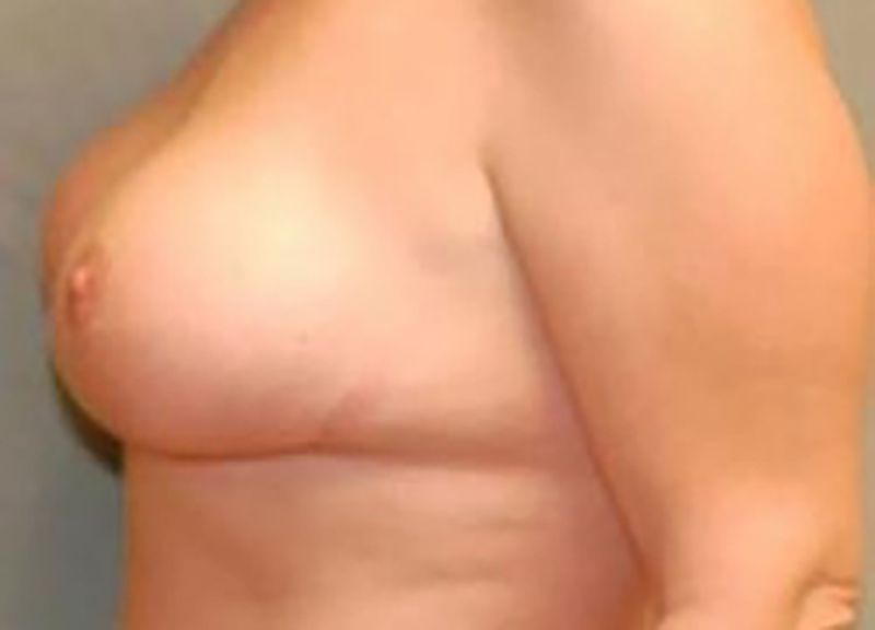 Breast Lift Before & After Photo