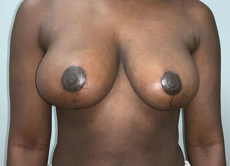 Breast Reduction Before & After Photo