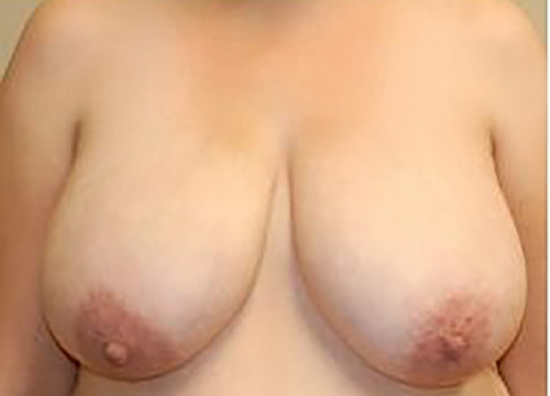 Breast Reduction Before & After Photo