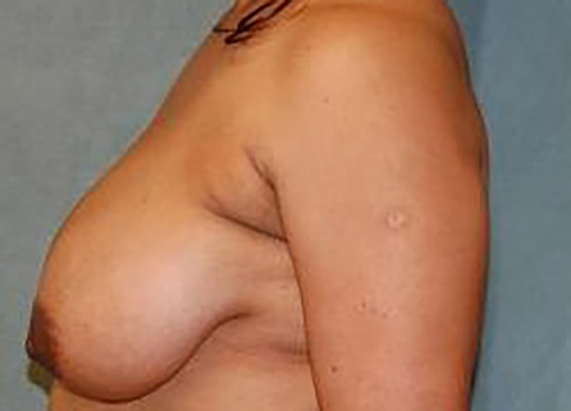 Breast Reduction Before & After Photo