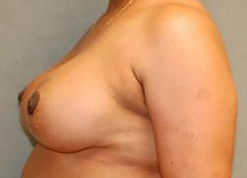 Breast Reduction Before & After Photo