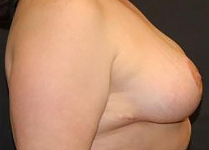 Breast Reduction Before & After Photo