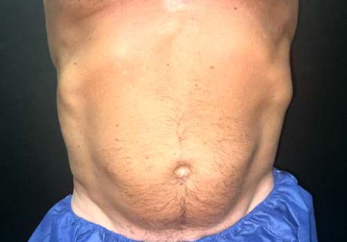 CoolSculpting Before & After Photo