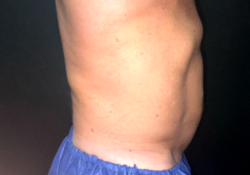 CoolSculpting Before & After Photo