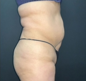 CoolSculpting Before & After Photo