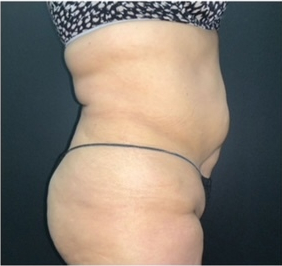 CoolSculpting Before & After Photo