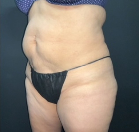 CoolSculpting Before & After Photo