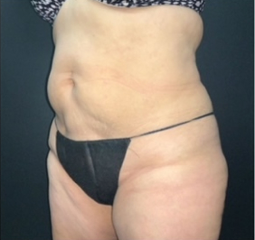 CoolSculpting Before & After Photo