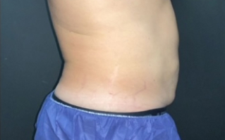 CoolSculpting Before & After Photo