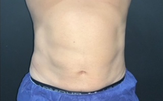 CoolSculpting Before & After Photo