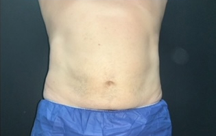 CoolSculpting Before & After Photo