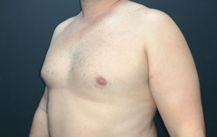 CoolSculpting Before & After Photo