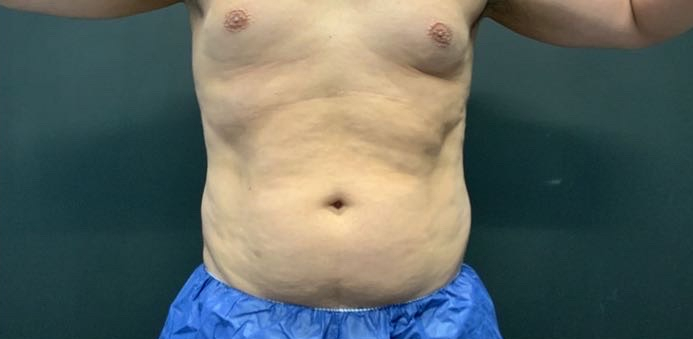 CoolSculpting Before & After Photo