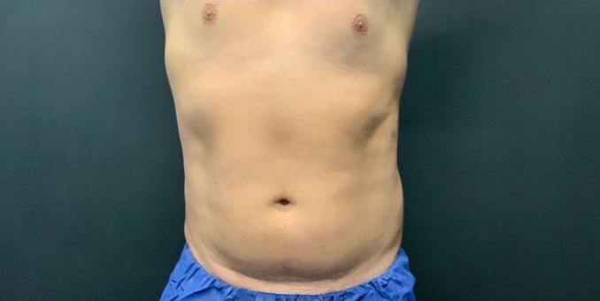 CoolSculpting Before & After Photo