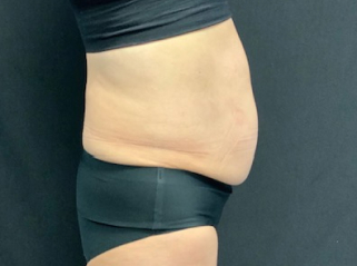 CoolSculpting Before & After Photo