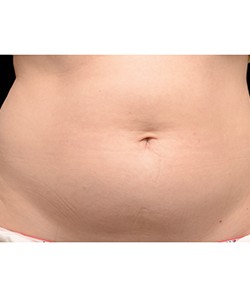 CoolSculpting Before & After Photo