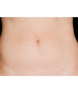 CoolSculpting Before & After Photo