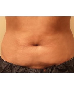 CoolSculpting Before & After Photo