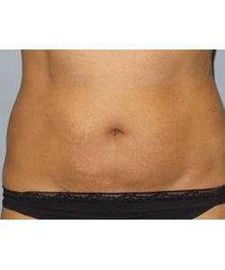 CoolSculpting Before & After Photo