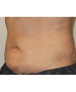 CoolSculpting Before & After Photo